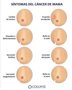 cancer de mama en naucalpan