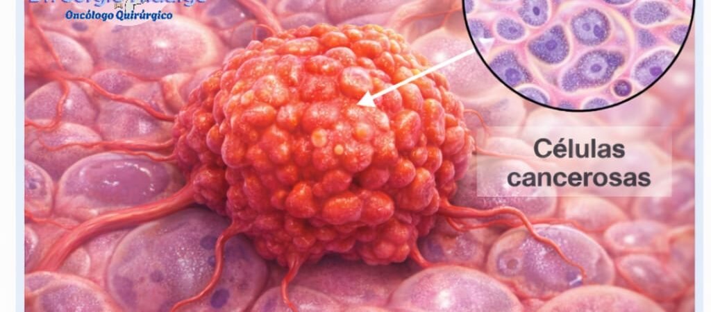 Lesiones Premalignas de Cérvix (NIC)