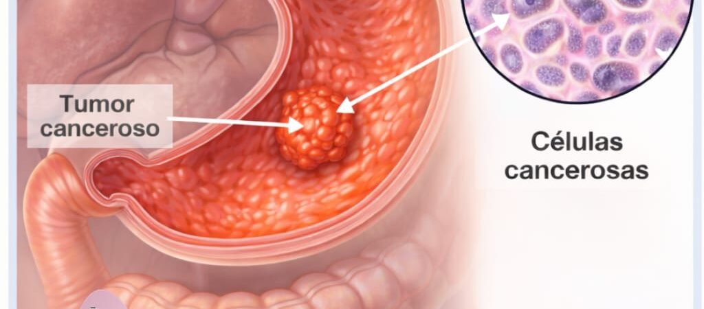 Helicobacter Pylori y Cáncer Gástrico