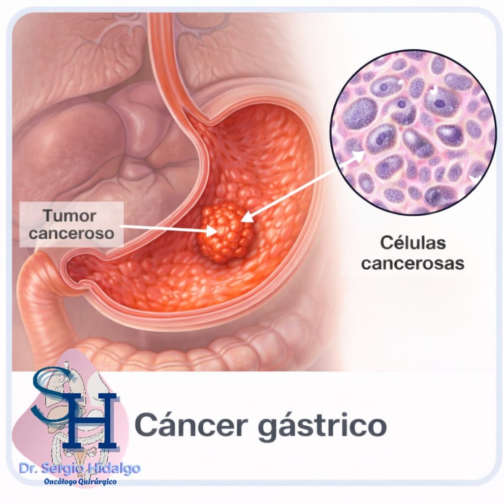 Cáncer gástrico o cáncer de estómago información para pacientes en Naucalpan
