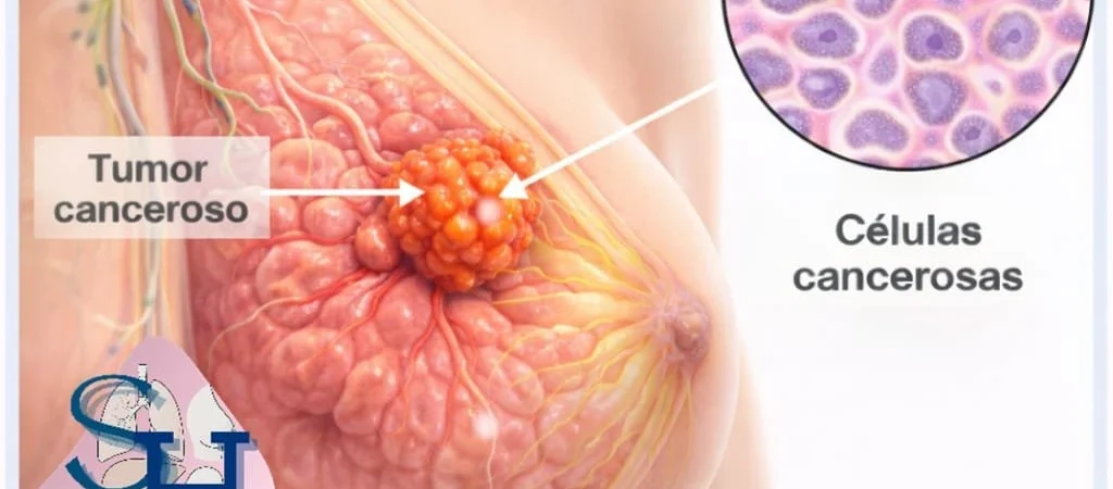 Biopsia trucut de mama